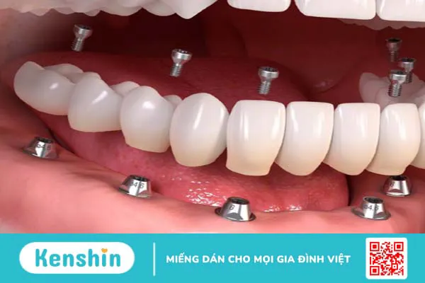 Tại sao phương pháp trồng răng Implant Tekka được ưa chuộng hiện nay? 1