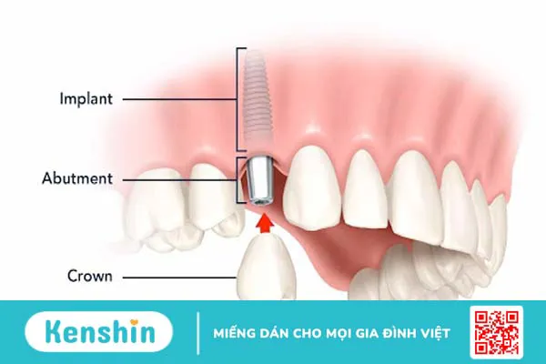 Tại sao phương pháp trồng răng Implant Tekka được ưa chuộng hiện nay? 2