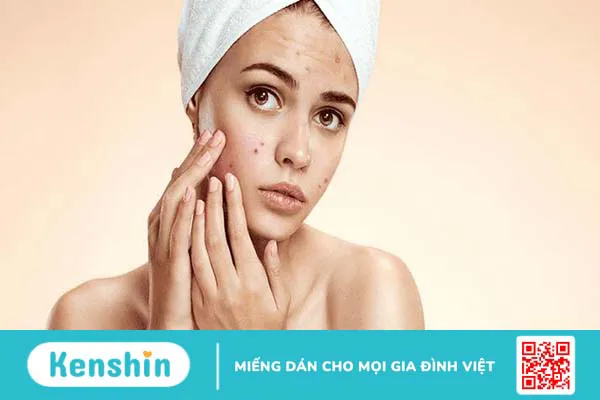 Mụn do nội tiết thường gặp ở tuổi dậy thì