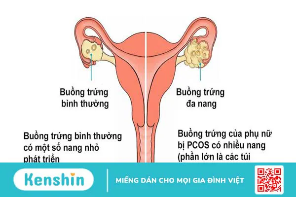 Đa nang buồng trứng gây mụn nội tiết