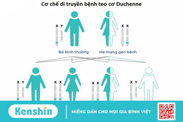 Teo cơ Duchenne: Dấu hiệu, nguyên nhân, chẩn đoán và điều trị 2