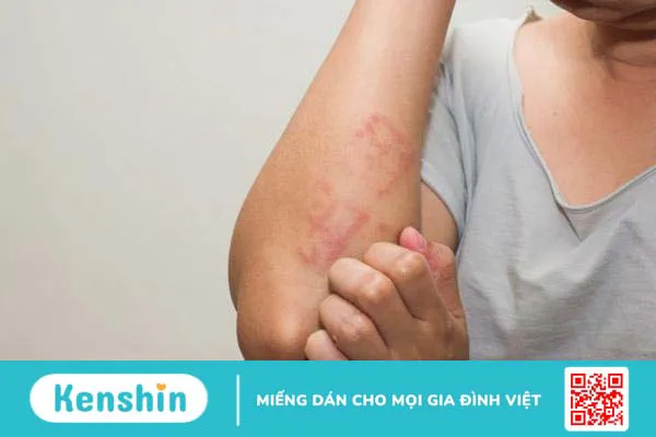 Test dị nguyên là gì? Tại sao cần thực hiện? Quy trình ra sao? 2