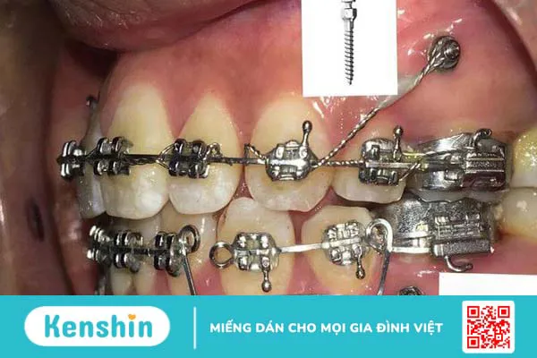 Tháo vít niềng răng có đau không? Tiêu chí để được tháo vít niềng răng 2