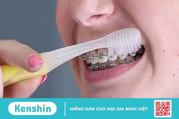 Tháo vít niềng răng có đau không? Tiêu chí để được tháo vít niềng răng 3