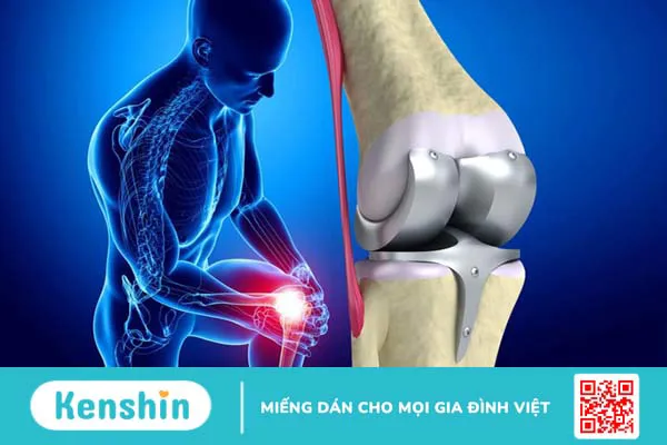 Thay khớp gối Medial Pivot là gì? Cần lưu ý gì sau khi thực hiện? 2