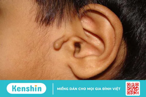 Thịt thừa ngoài tai và những điều bạn cần biết 1