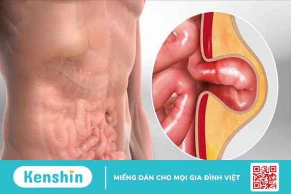 Mổ thoát vị bẹn có ảnh hưởng đến sinh sản không? 1