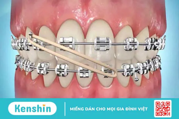 Thun liên hàm là gì? Ưu nhược điểm của thun liên hàm 2