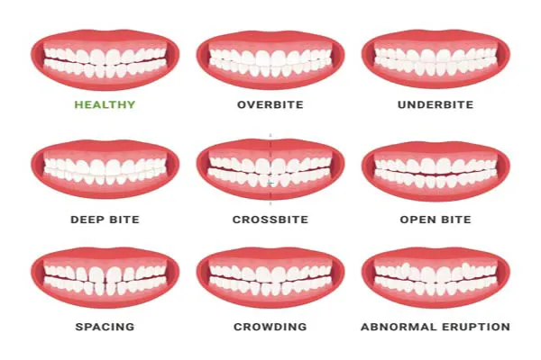 Thun liên hàm là gì? Ưu nhược điểm của thun liên hàm 3