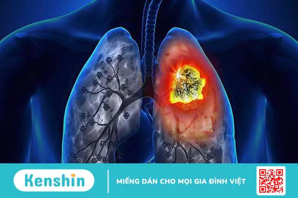 Tìm hiểu về các bệnh ung thư phổ biến và biến chứng 2