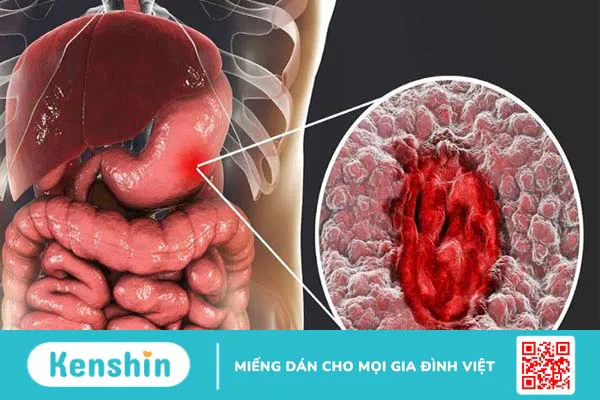 Tìm hiểu về các bệnh ung thư phổ biến và biến chứng 3