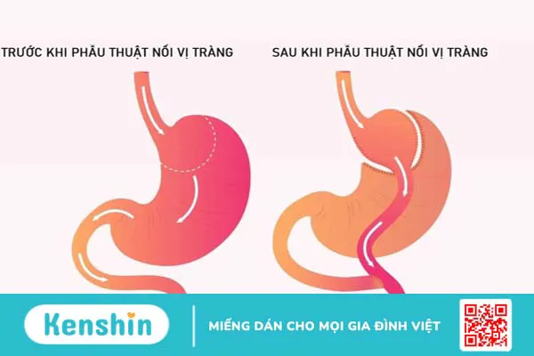 Tìm hiểu chi tiết về phẫu thuật nối vị tràng 1