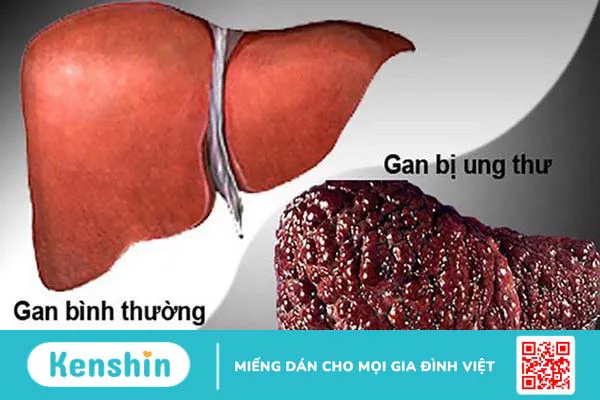 Tìm hiểu người lành mang virus viêm gan b có lây không?