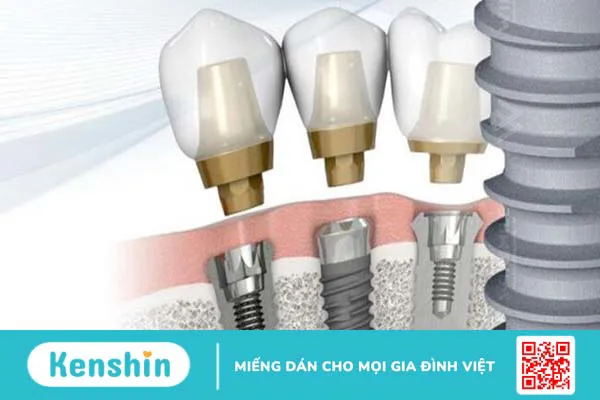 Những ưu điểm của trụ Implant DIO 2