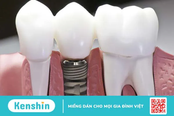 Những ưu điểm của trụ Implant DIO 3