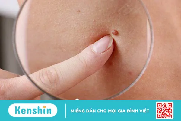 Tìm hiểu ung thư da hắc tố di căn hay không? 2