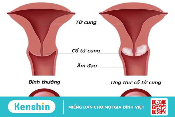 Tìm hiểu về 5 loại ung thư thường gặp ở nữ giới 1