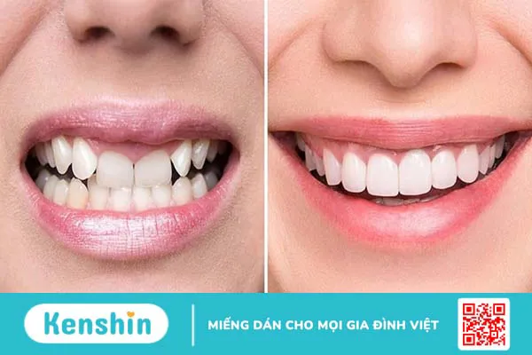 Tìm hiểu về mão răng trong nha khoa thẩm mỹ 3