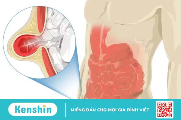 Tìm hiểu về phương pháp Lichtenstein trong điều trị thoát vị bẹn 1