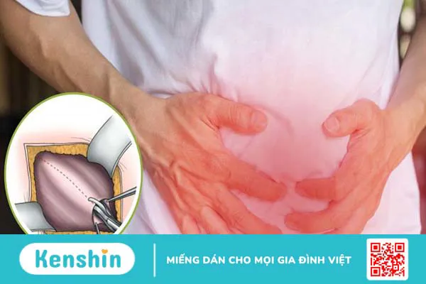 Tìm hiểu về phương pháp Lichtenstein trong điều trị thoát vị bẹn 4