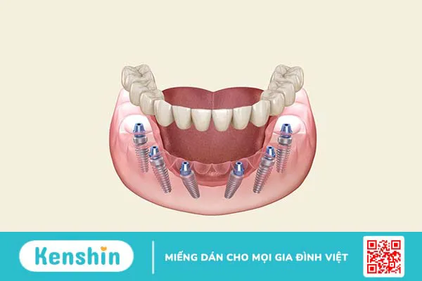 Trồng răng implant all on 6 có nên hay không? 1