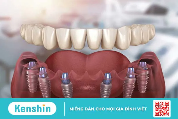 Trồng răng implant all on 6 có nên hay không? 2