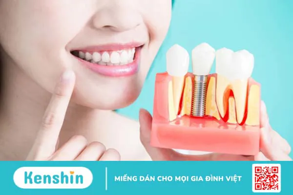 Trồng răng implant all on 6 có nên hay không? 4