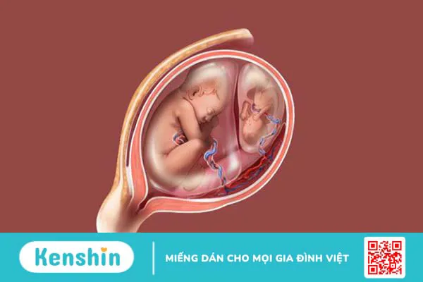 Tìm hiểu về tình trạng 1 túi thai có 2 phôi thai 1