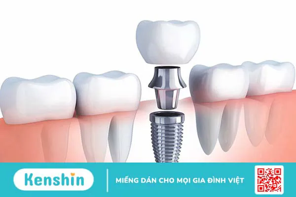 Trụ implant straumann và đặc điểm nổi trội 1