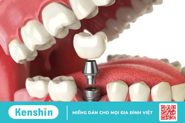 Trụ implant straumann và đặc điểm nổi trội 4