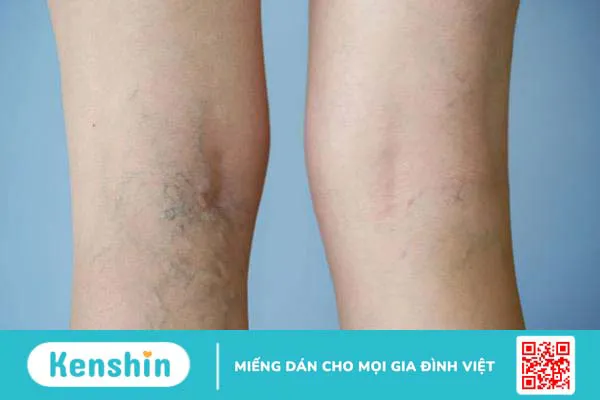 Tìm hiểu về vớ gối y khoa chống giãn tĩnh mạch BioHealth Compression I 1