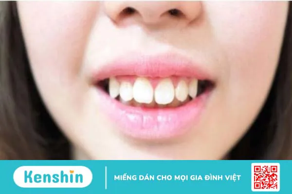 Giải đáp: Tình trạng răng hô nặng có hết được không? 1