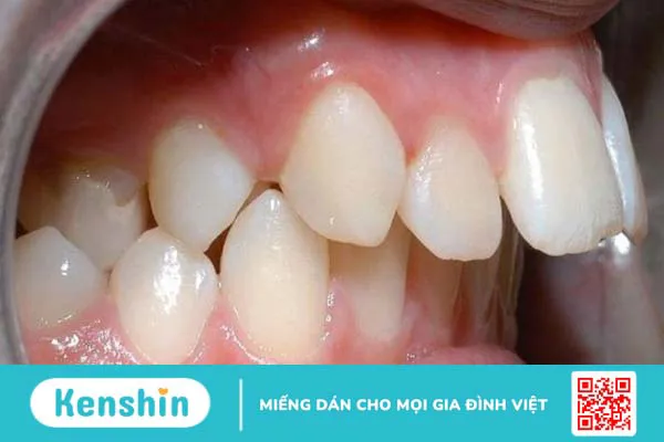 Giải đáp: Tình trạng răng hô nặng có hết được không? 3