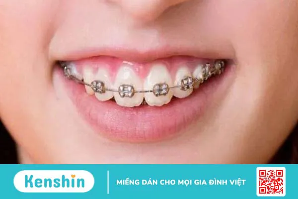 Giải đáp: Tình trạng răng hô nặng có hết được không? 4