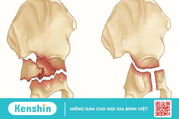 Tổn thương đám rối thần kinh thắt lưng