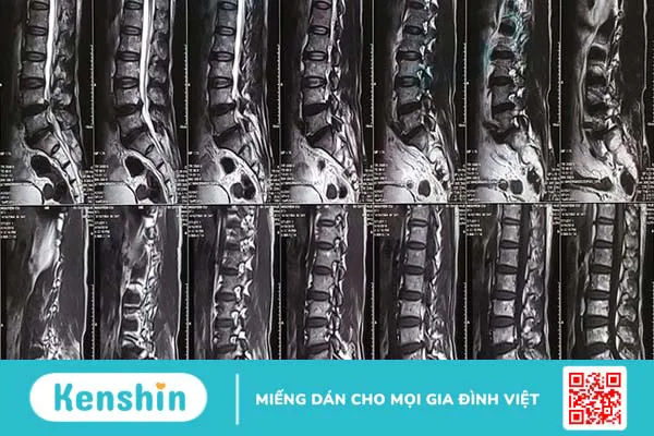 Tổn thương đám rối thần kinh thắt lưng