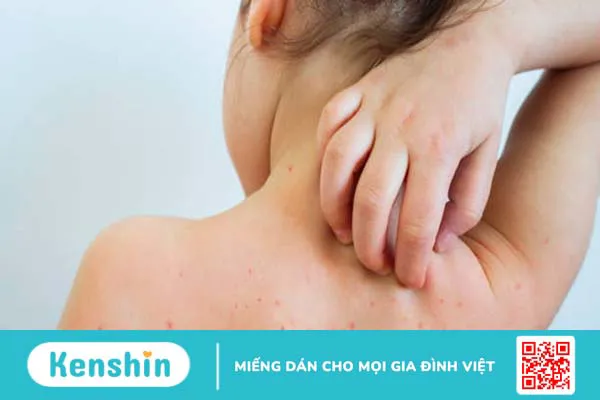 Tổng hợp hình ảnh thủy đậu qua các giai đoạn 5