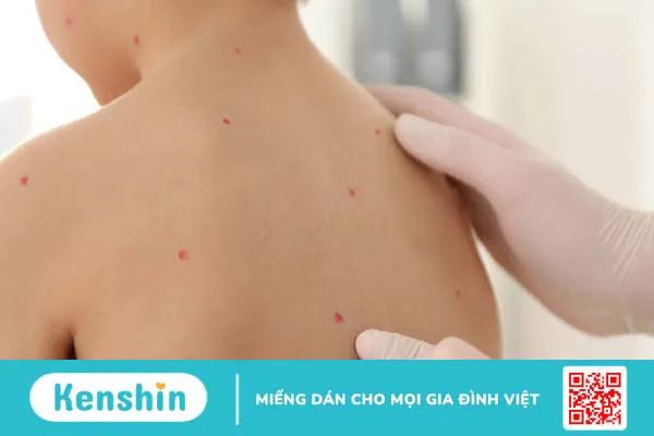 Tổng hợp hình ảnh thủy đậu qua các giai đoạn 7