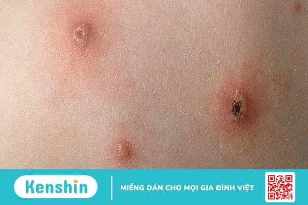 Tổng hợp hình ảnh thủy đậu qua các giai đoạn 3