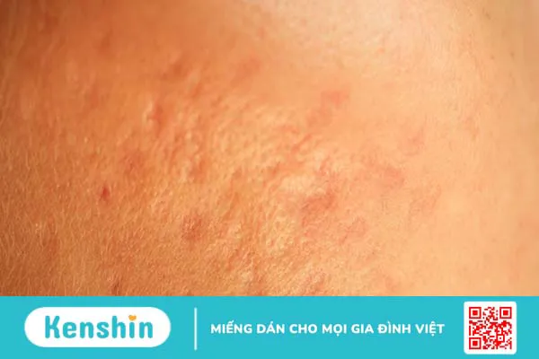 Tổng hợp hình ảnh thủy đậu qua các giai đoạn 10