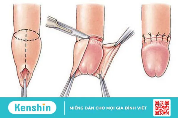 Tổng quan về hiện tượng dính bao quy đầu và phương pháp phòng tránh cho trẻ nam 1