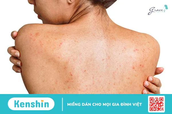 Top 5 sữa tắm trị mụn lưng cho bà bầu nhất định phải thử 1