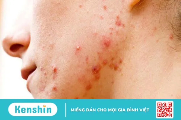 Top cách trị mụn bọc nhanh nhất trong 1 đêm vừa an toàn vừa hiệu quả 1