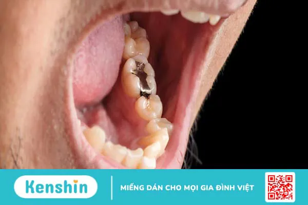 Trám răng bằng Amalgam có độc không? Ưu và nhược điểm khi trám răng bằng Amalgam 1