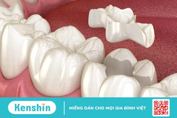 Những điều cần biết về trám răng inlays 1