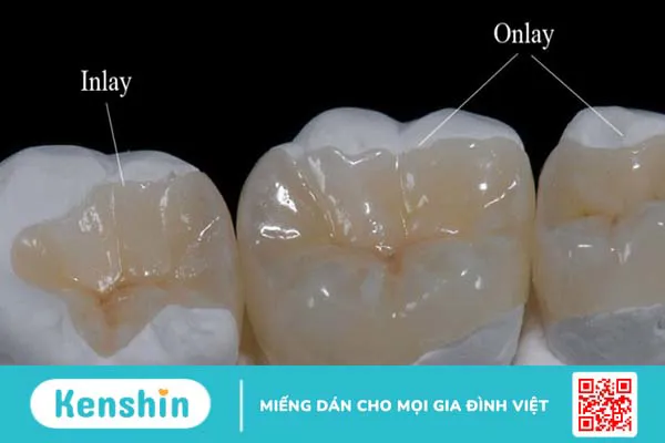 Những điều cần biết về trám răng inlays 2