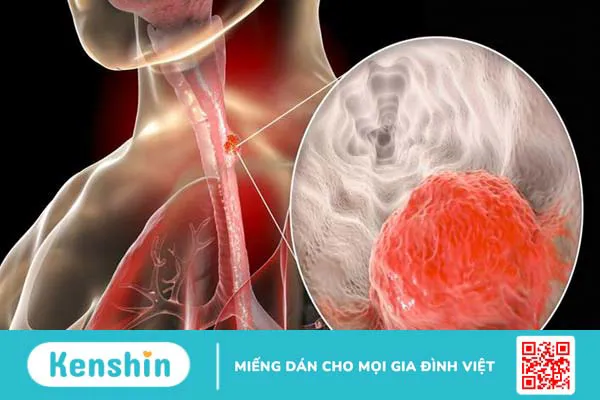 Trào ngược dạ dày nghẹn cổ họng là gì? Có nguy hiểm không? 3