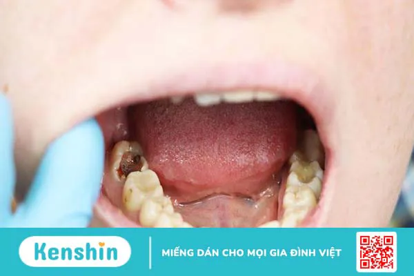 Trẻ 7 tuổi bị sâu răng hàm phải làm sao? 1