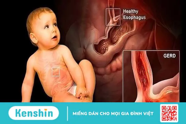 Nguyên nhân nào gây ra hiện tượng trẻ sơ sinh phì nước bọt khi ngủ?  2