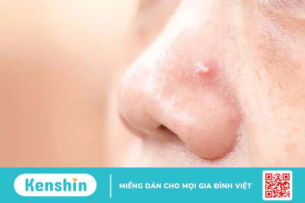 Trị sẹo mụn như thế nào để cải thiện làn da đẹp hơn 1